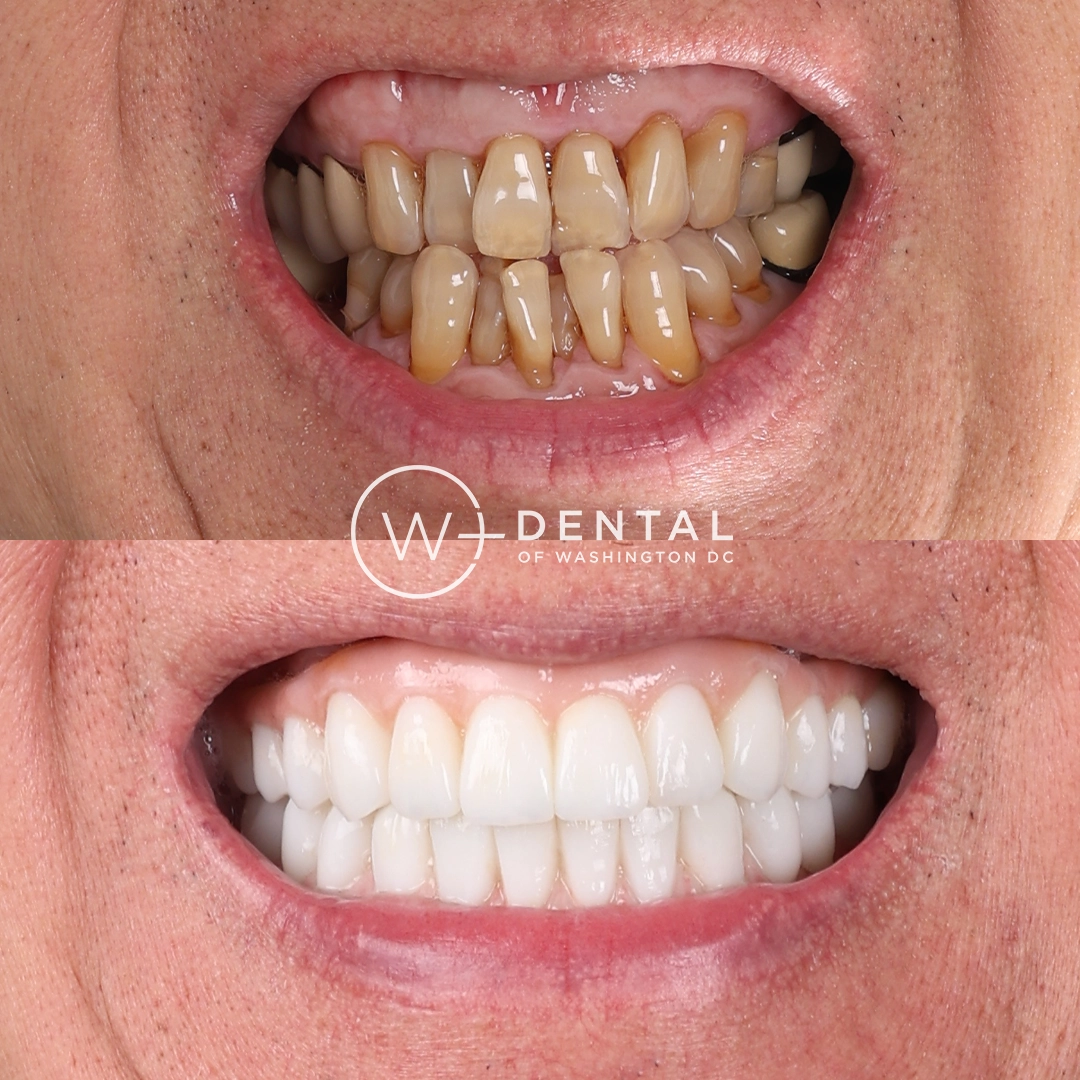 before and after dental bonding for a chipped tooth