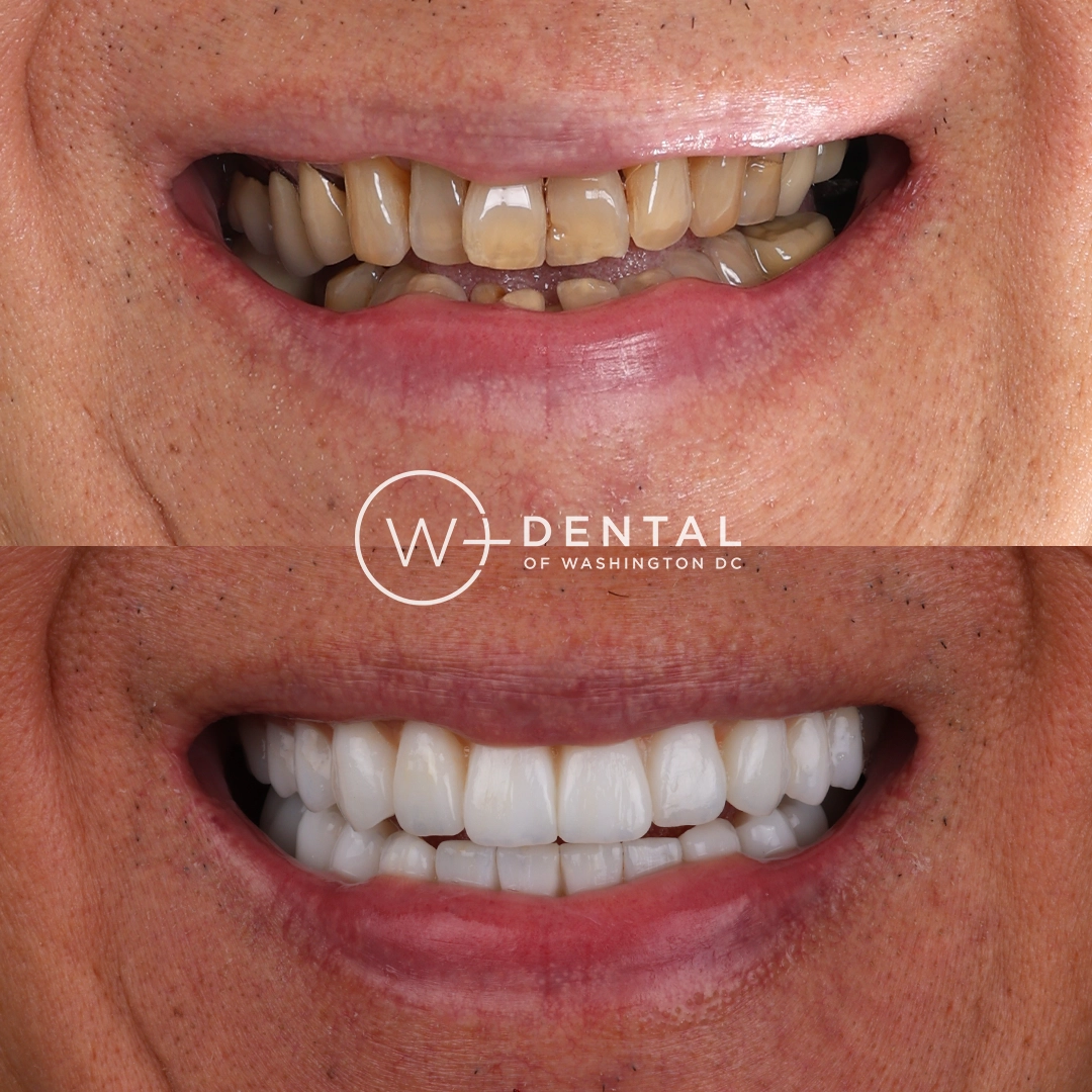 before and after dental bonding for a chipped tooth