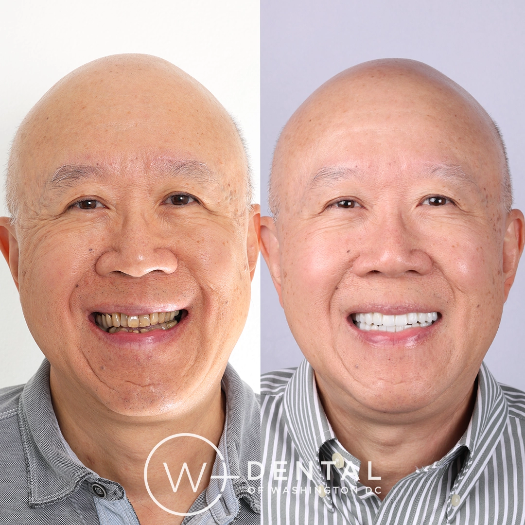 Before and after a smile makeover  with All-on-X dental implants at W Plus Dental – full arch tooth replacement transforming missing and failing teeth to a complete, permanent smile, Washington DC