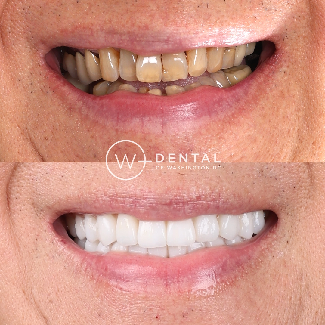 before and after dental bonding for a chipped tooth