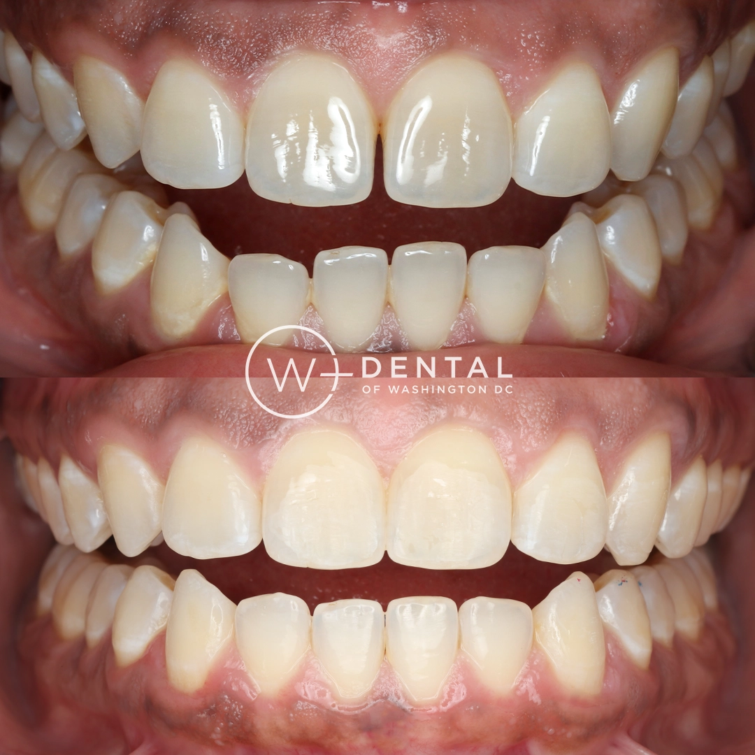 before and after dental bonding for a chipped tooth