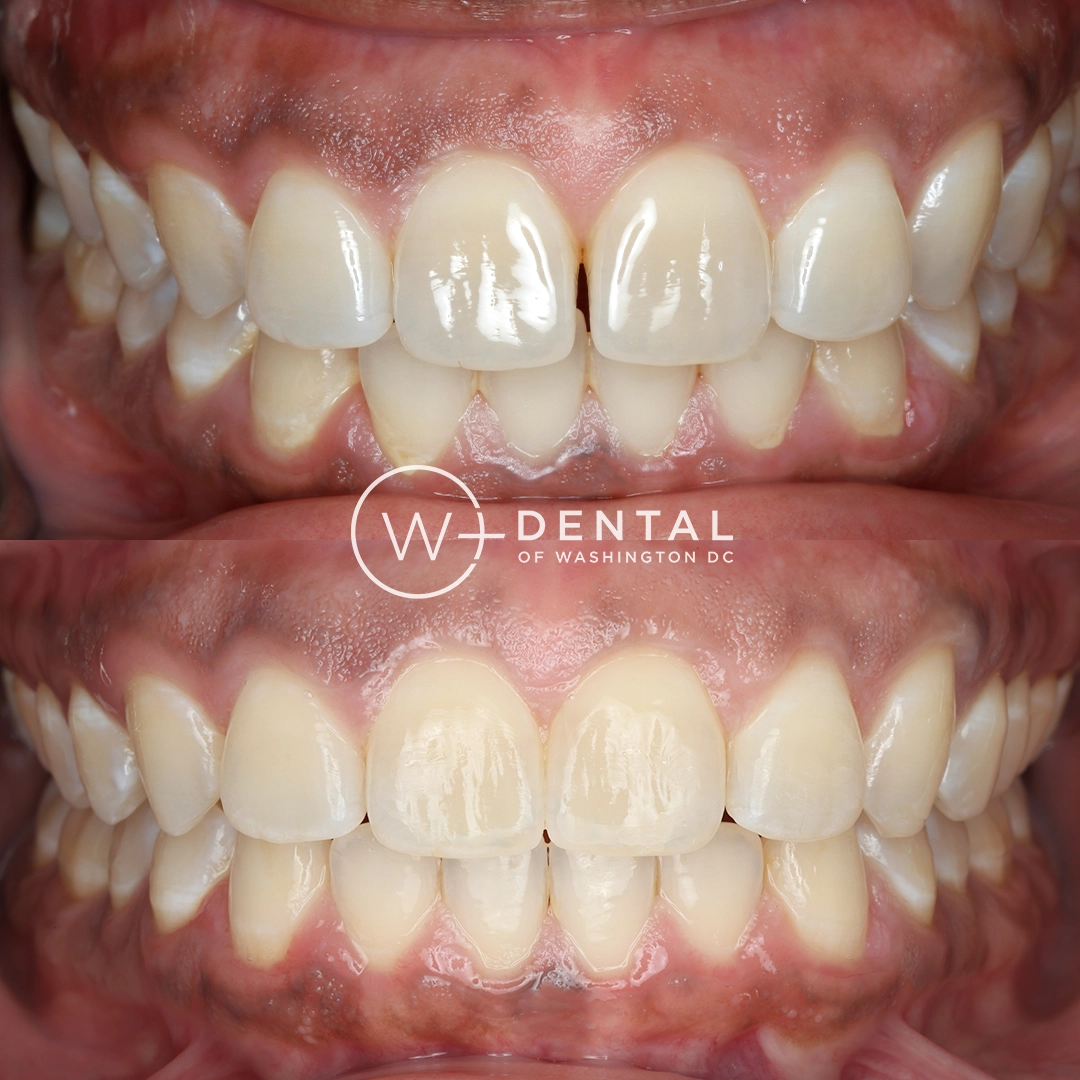 Invisalign before and after showing crowded teeth transformed into a straighter, more aligned smile at W Plus Dental in Washington, DC.