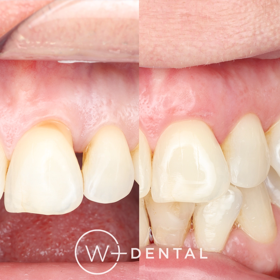before and after dental bonding for a chipped tooth