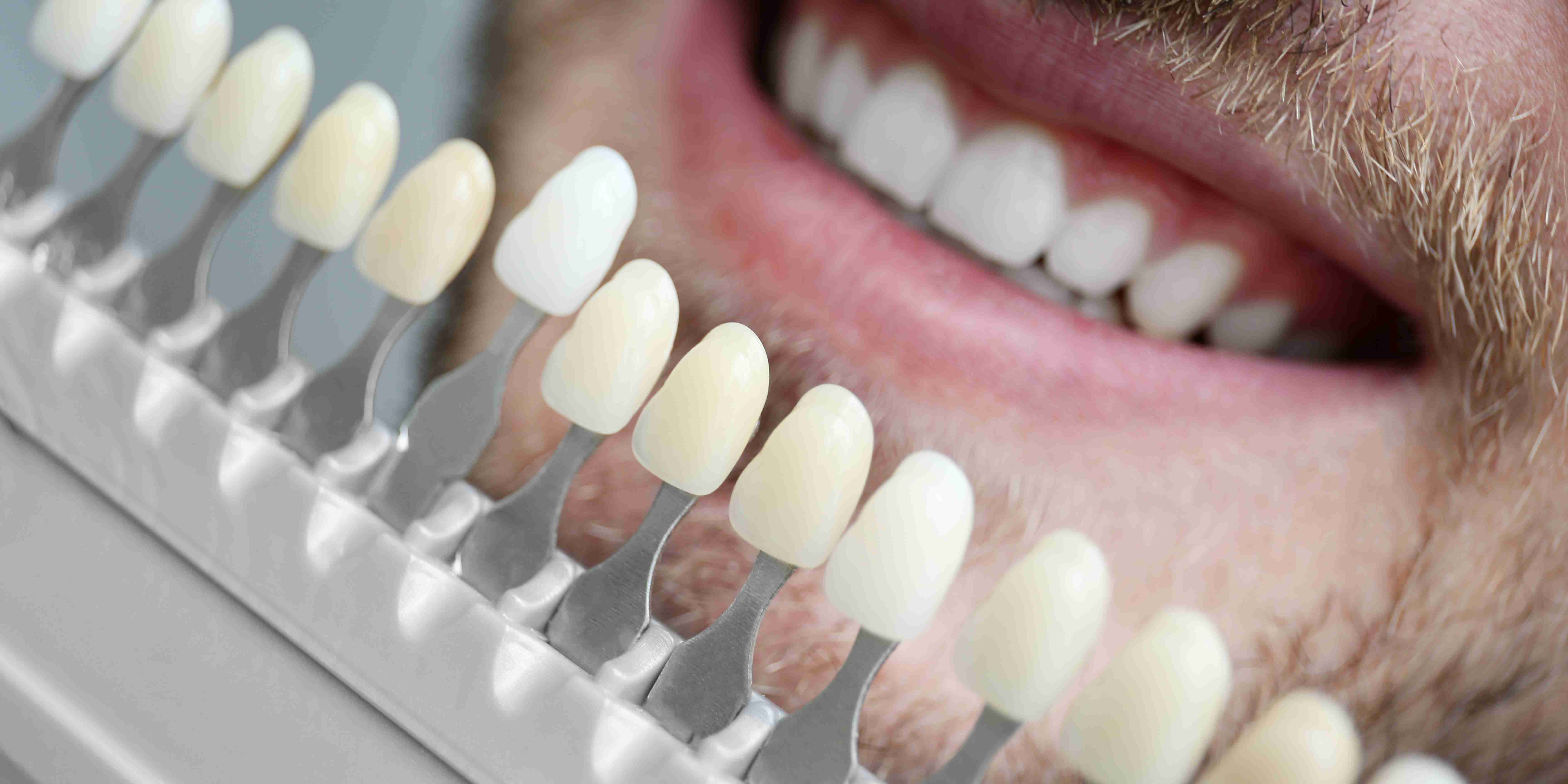 Porcelain veneers before and after in Washington DC