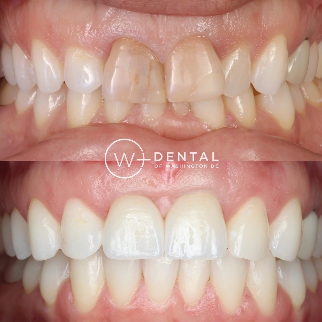 before and after dental bonding for a chipped tooth
