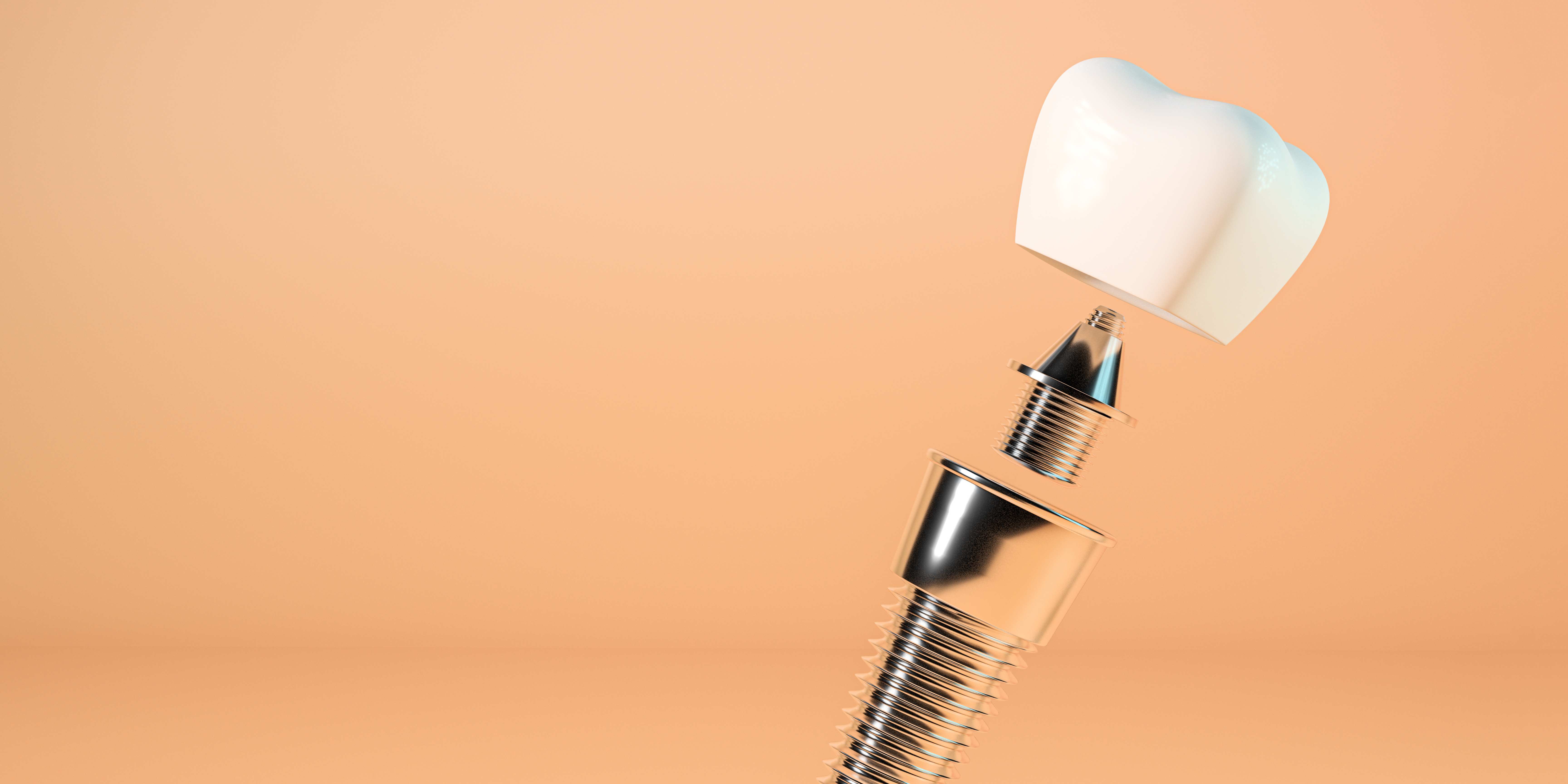 Are Dental Implants Worth It? | Dental Implants Washington DC