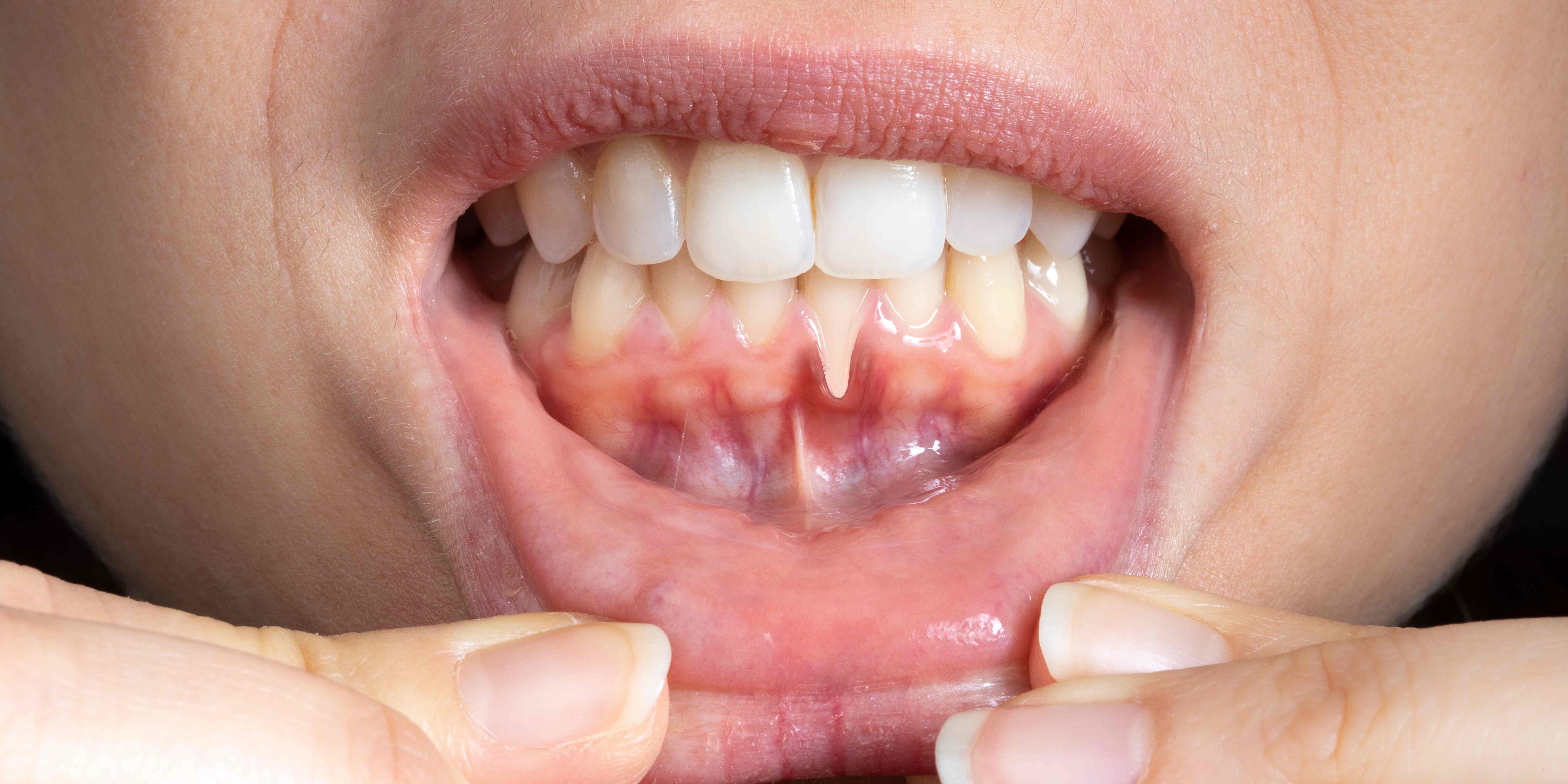 Gum Grafting Post-Op Instructions in Washington, DC | W Plus Dental