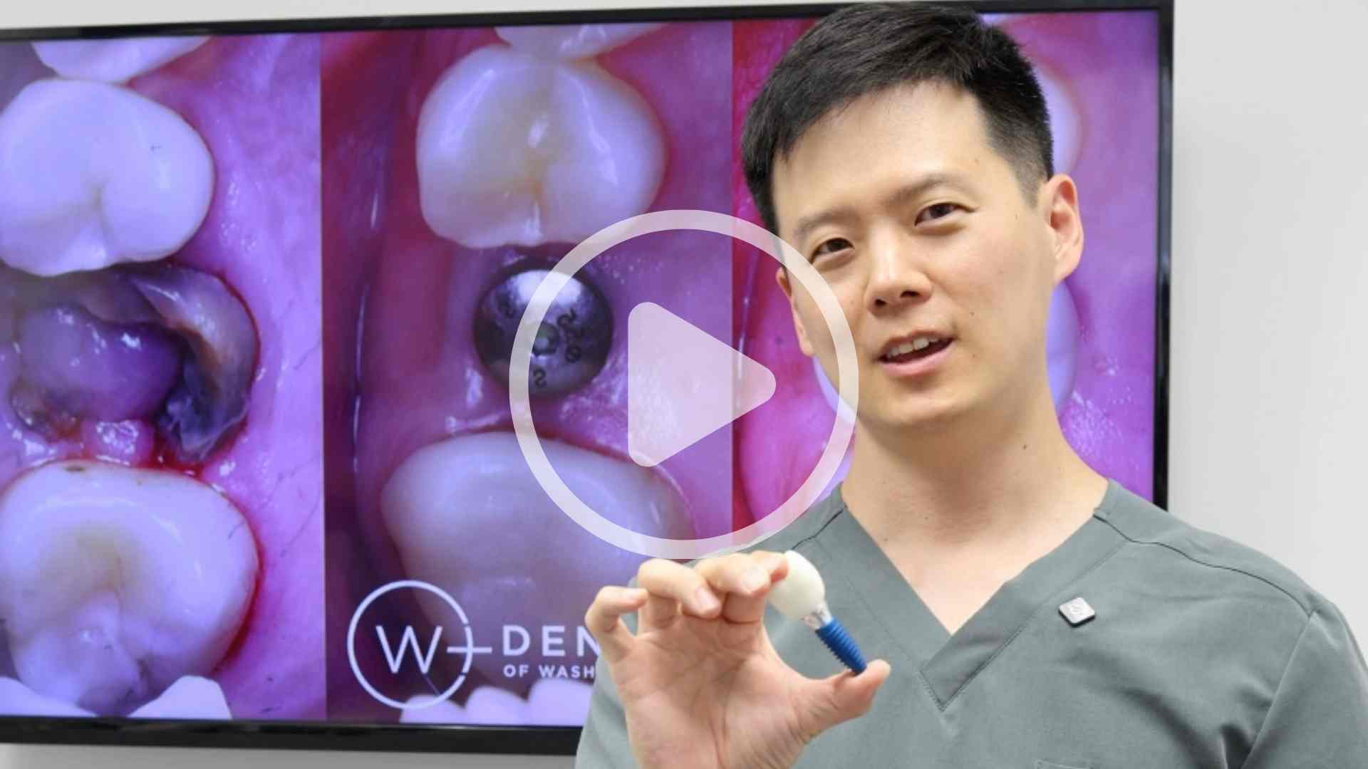 How Do Dental Implants Work? The Step-by-Step Process & What to Expect | Washington, DC Dentist