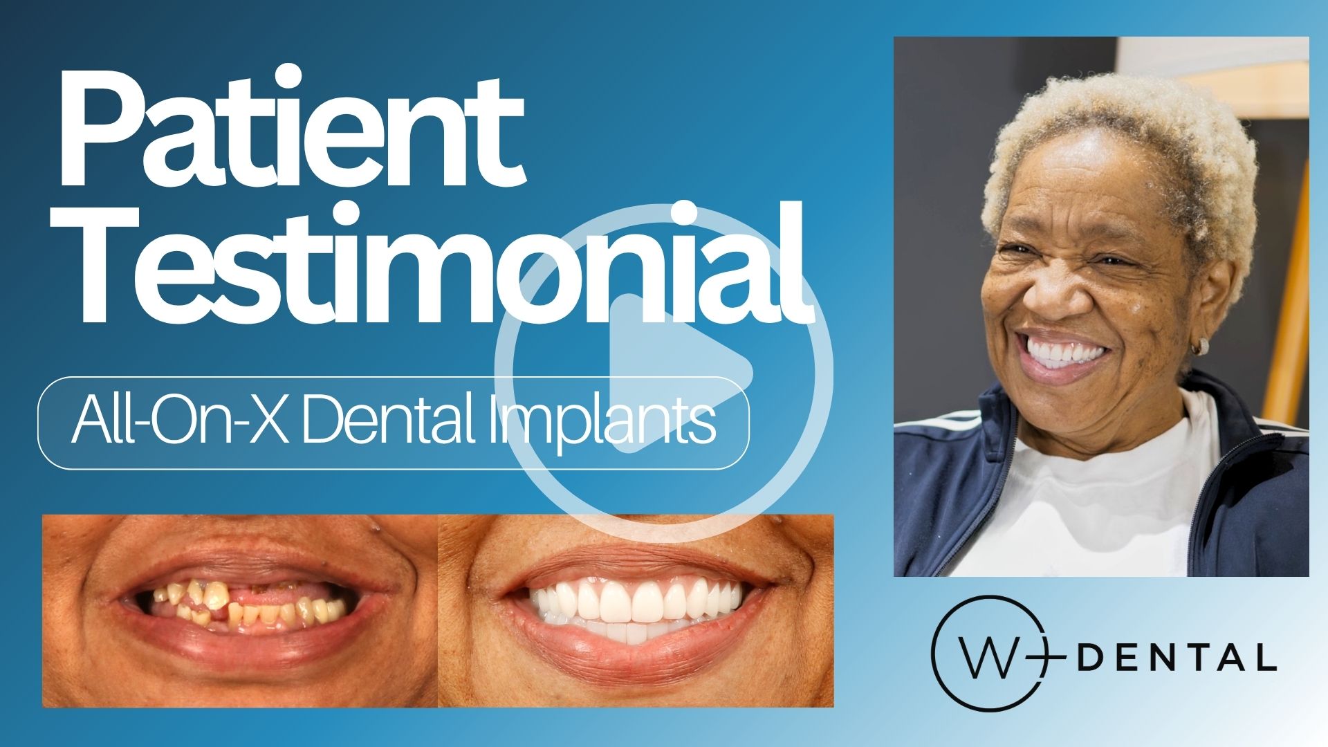 Dental Implant Patient Testimonial Dr. John Ku at W Plus Dental Washington, DC