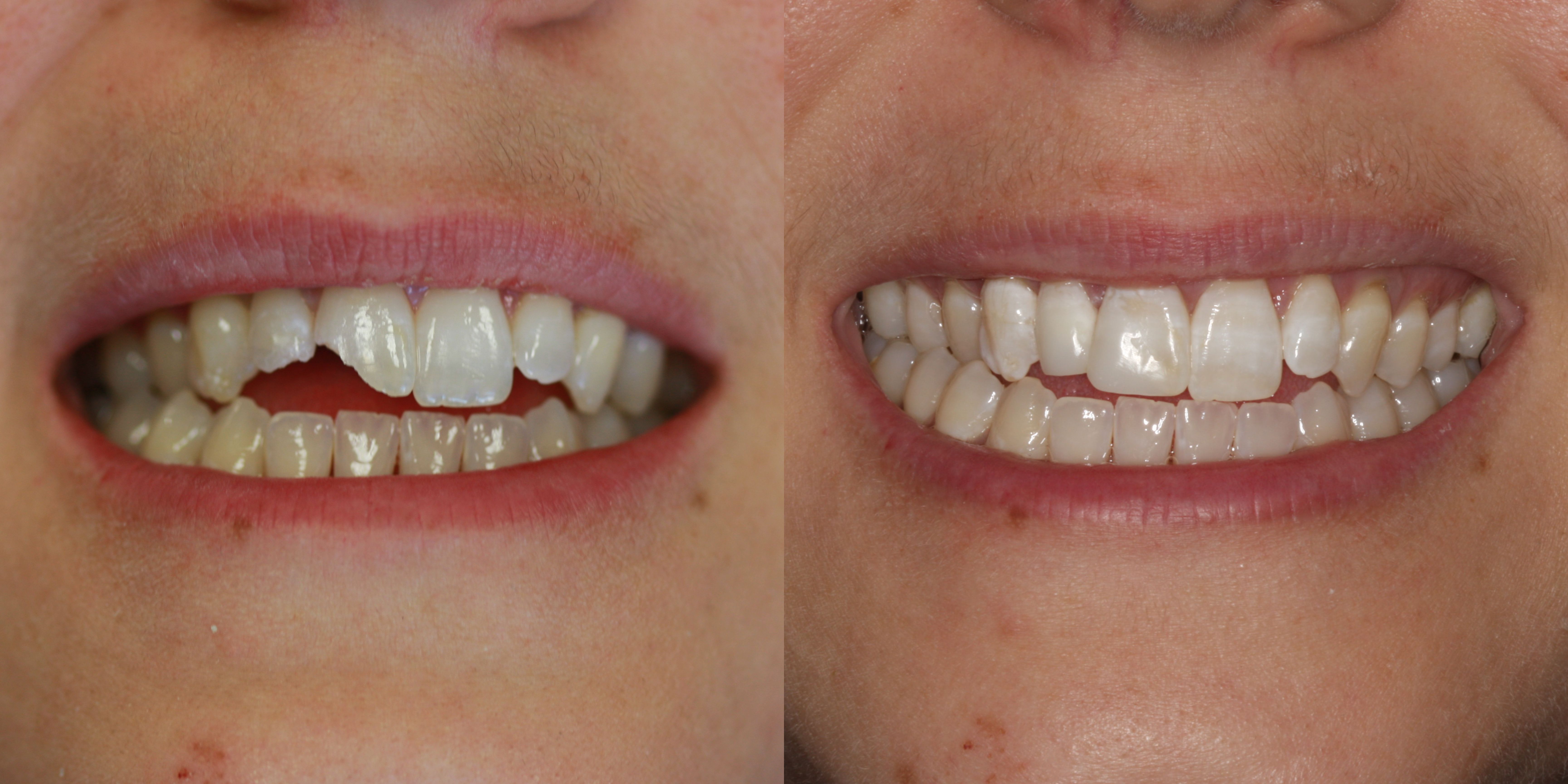 How to Fix a Chipped Front Tooth | Dental Bonding Washington DC