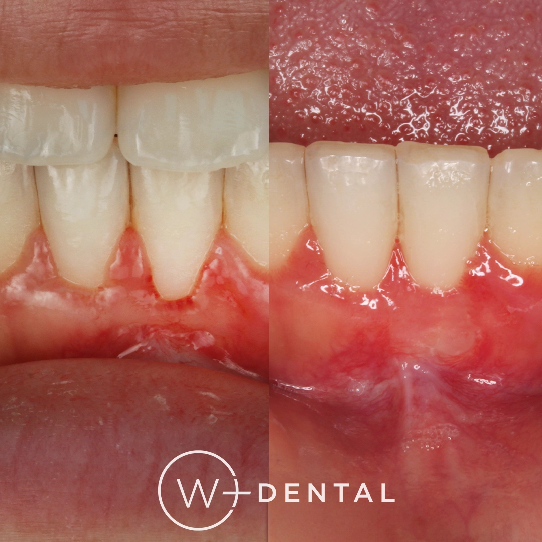before and after dental bonding for a chipped tooth