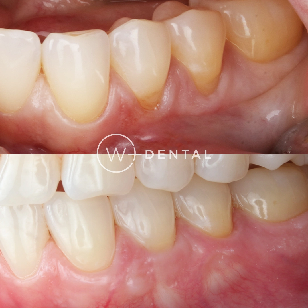 before and after dental bonding for a chipped tooth
