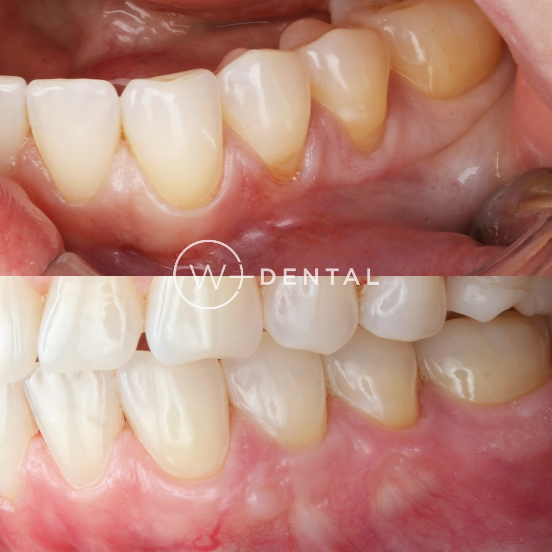 before and after dental bonding for a chipped tooth