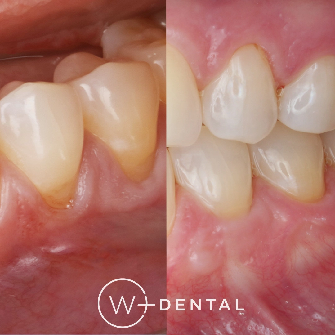 before and after dental bonding for a chipped tooth