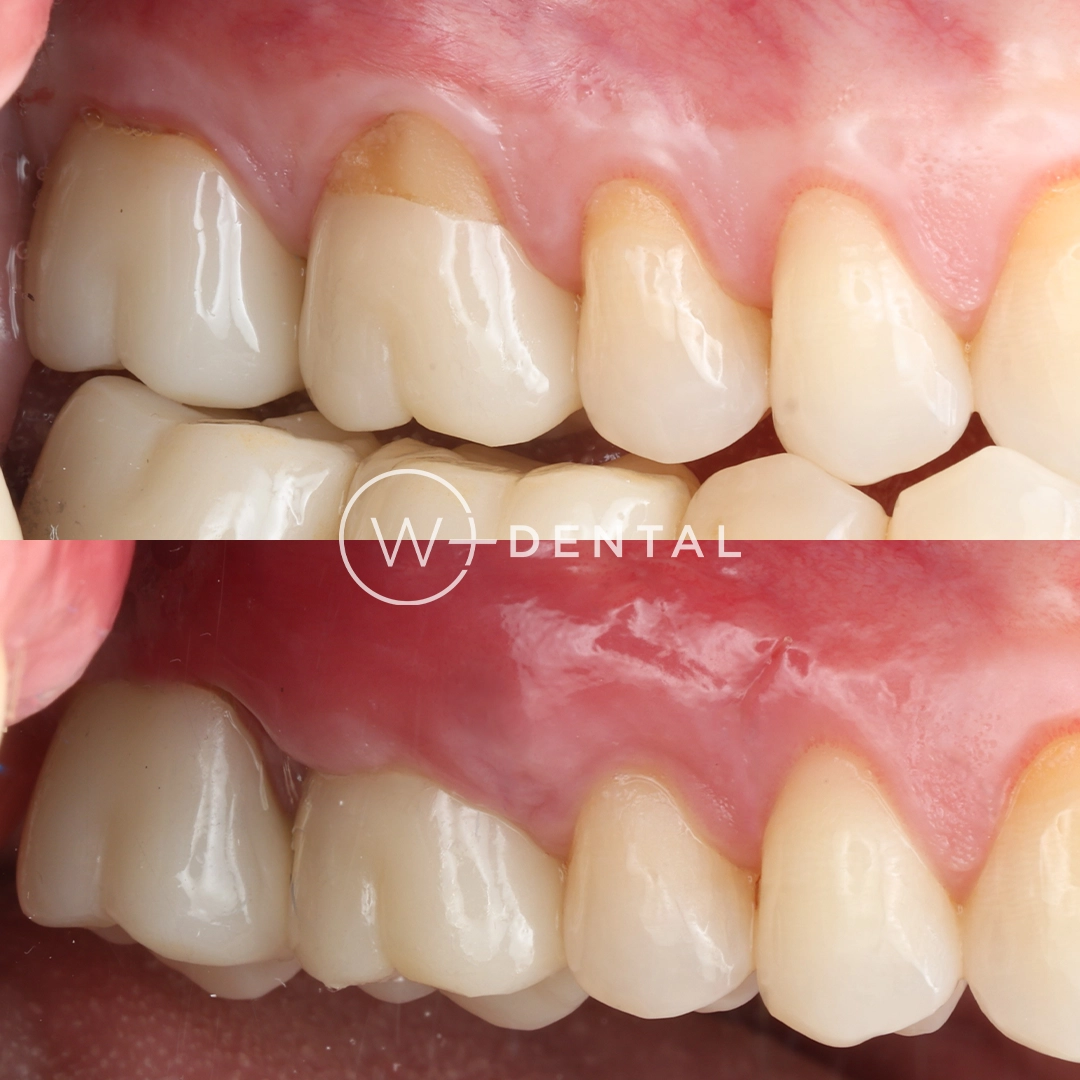 before and after dental bonding for a chipped tooth