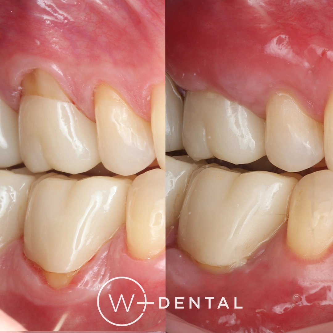 before and after dental bonding for a chipped tooth