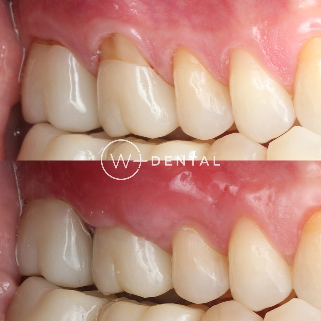 before and after dental bonding for a chipped tooth