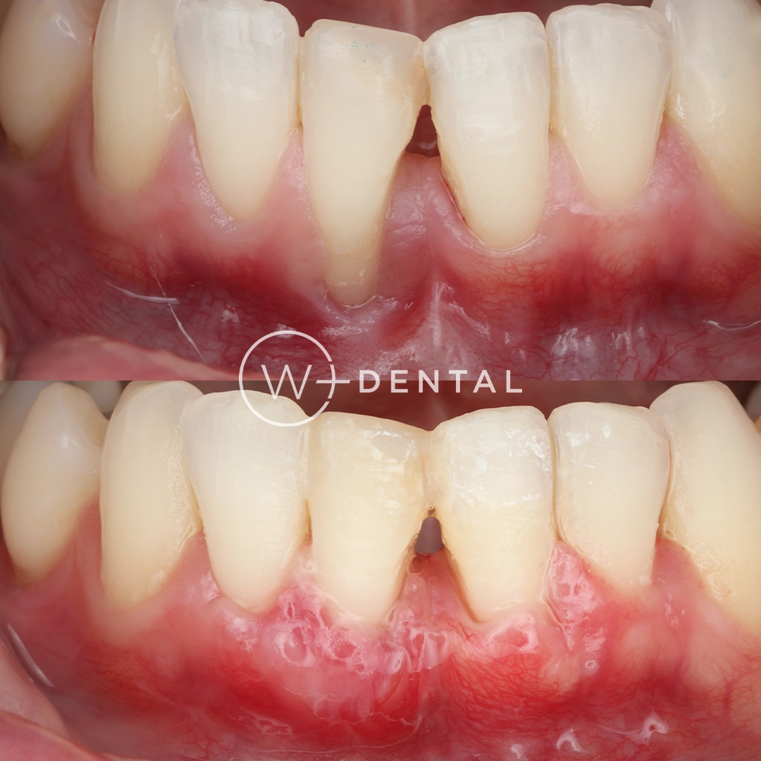 before and after dental bonding for a chipped tooth