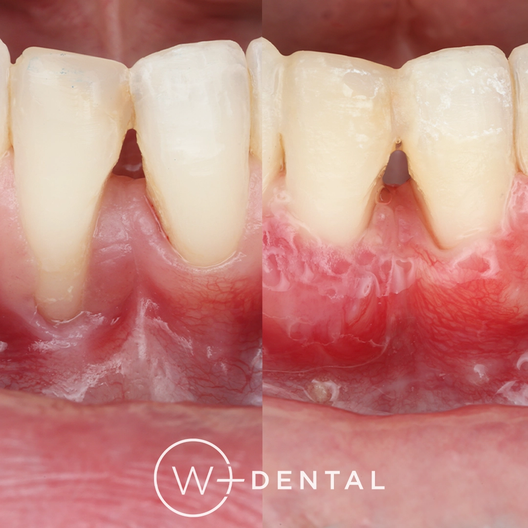 before and after dental bonding for a chipped tooth