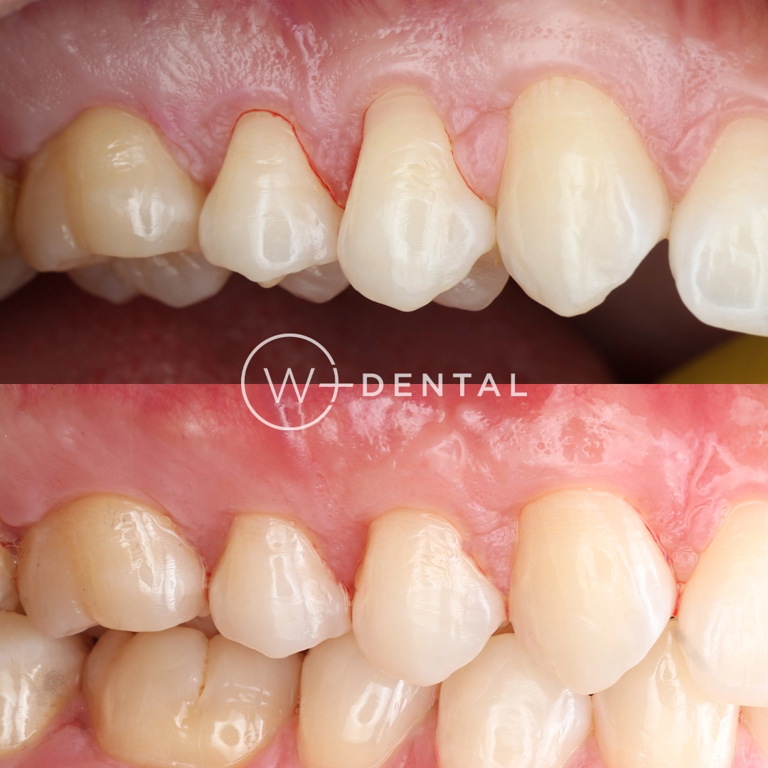 Gum graft before and after showing improved coverage of an exposed tooth root
