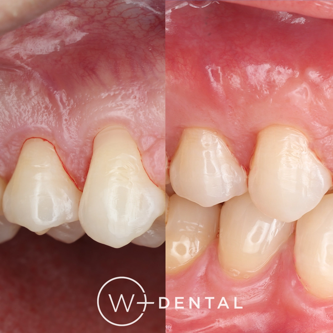 before and after dental bonding for a chipped tooth