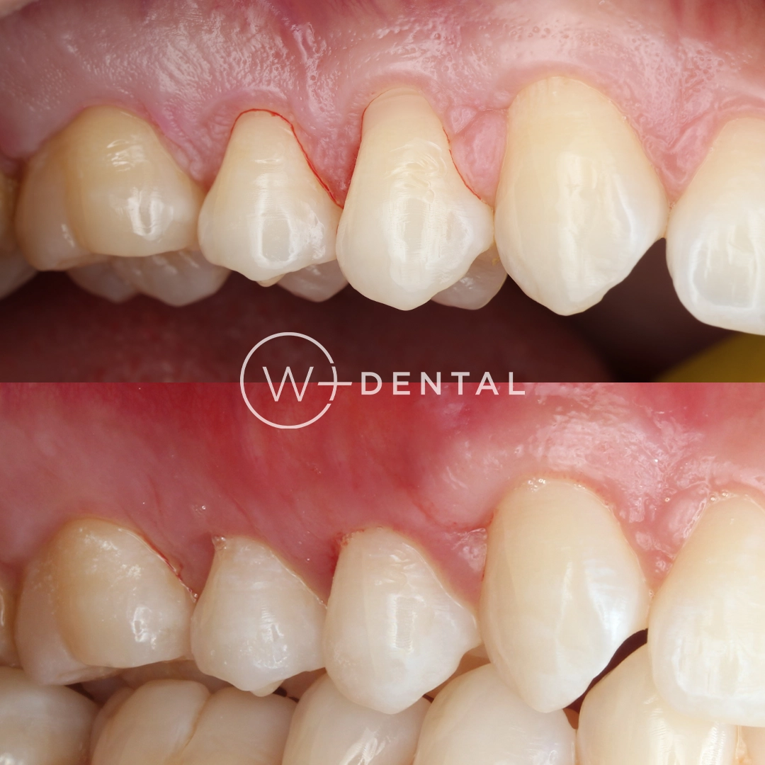 before and after dental bonding for a chipped tooth