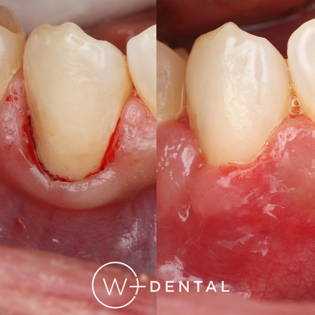 Before and after gum grafting for gum recession using a connective tissue graft