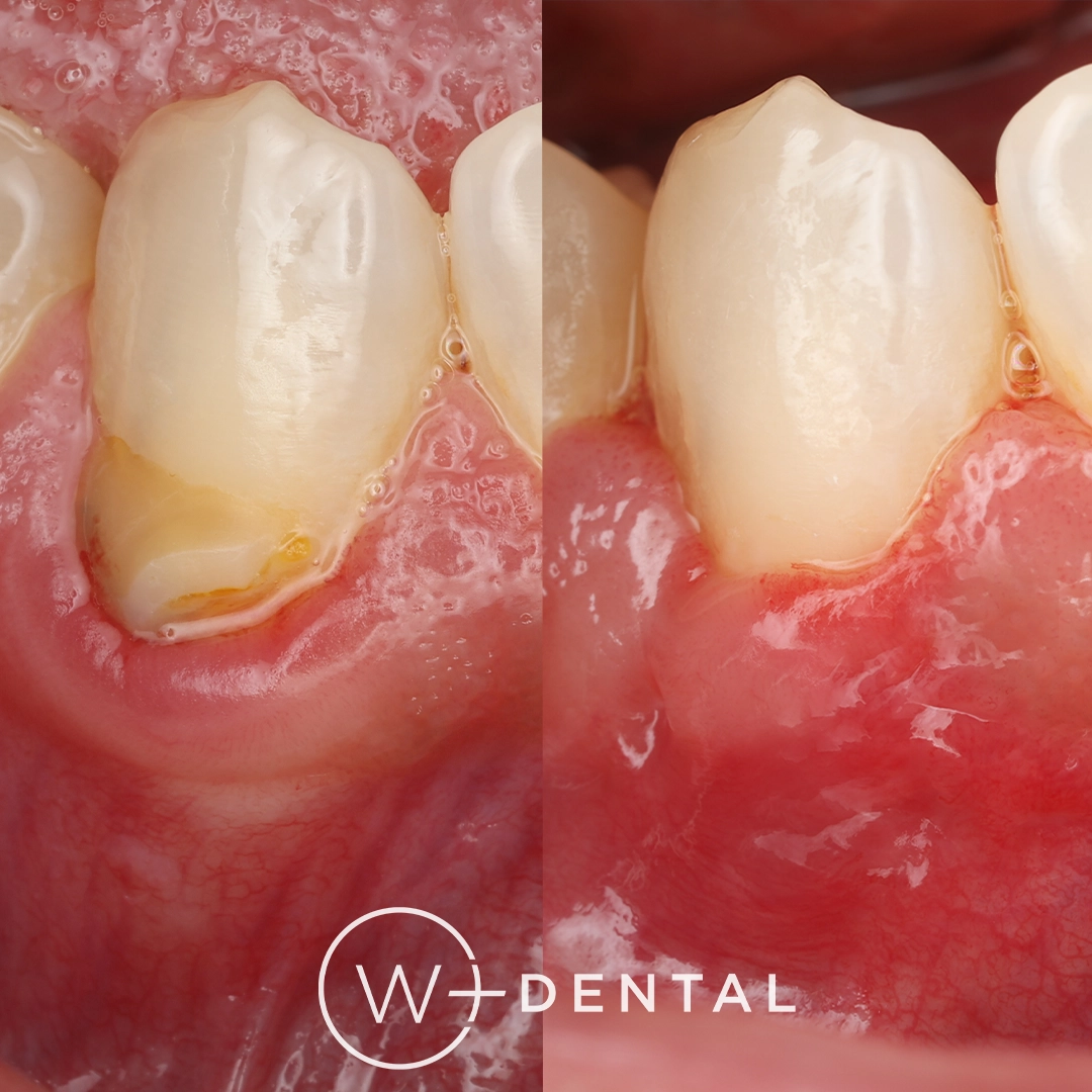 before and after dental bonding for a chipped tooth