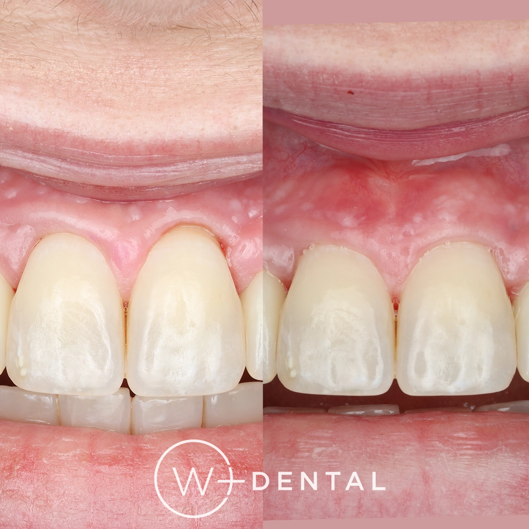 Before and after gum grafting for gum recession using a connective tissue graft