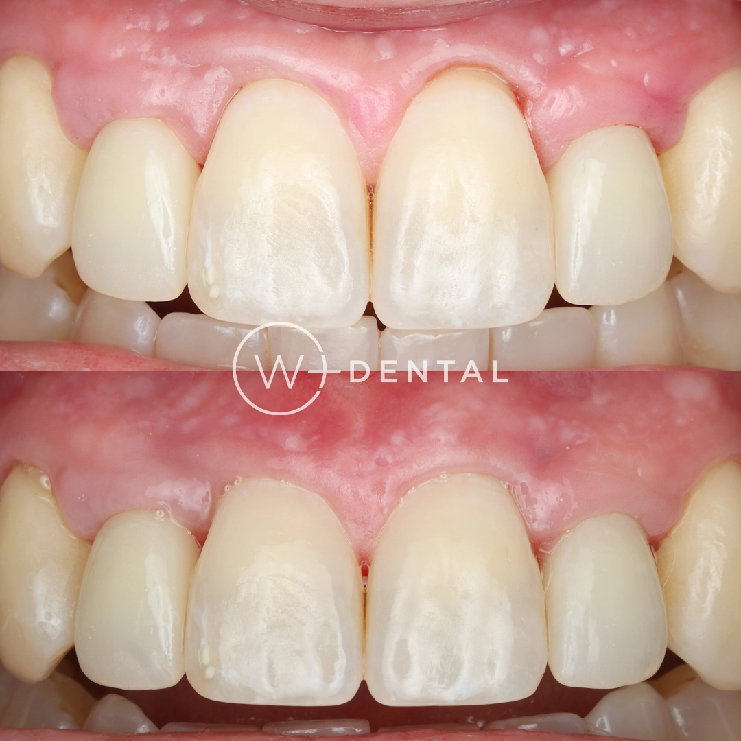 before and after dental bonding for a chipped tooth