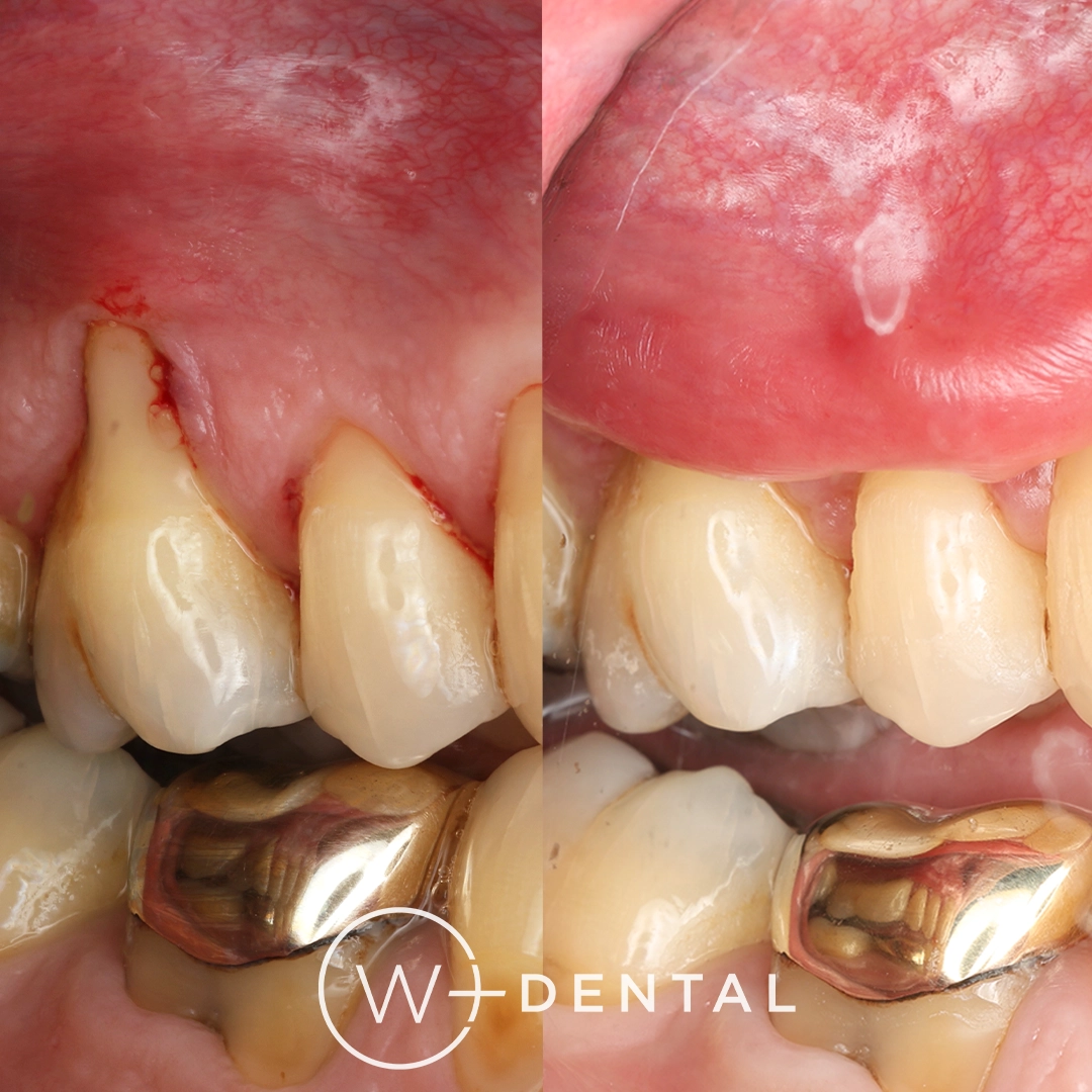 before and after dental bonding for a chipped tooth