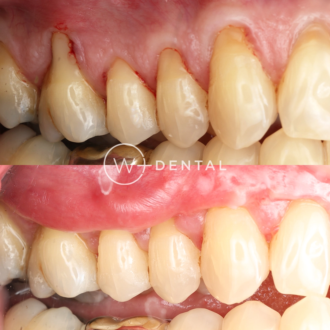 Before and after gum graft surgery using tissue from the roof of the mouth