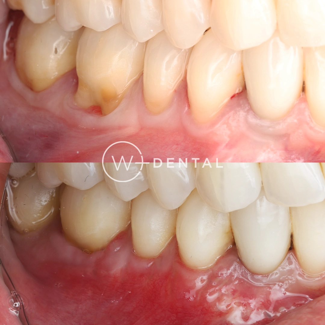 Before and after gum grafting for gum recession using a CTG gum graft