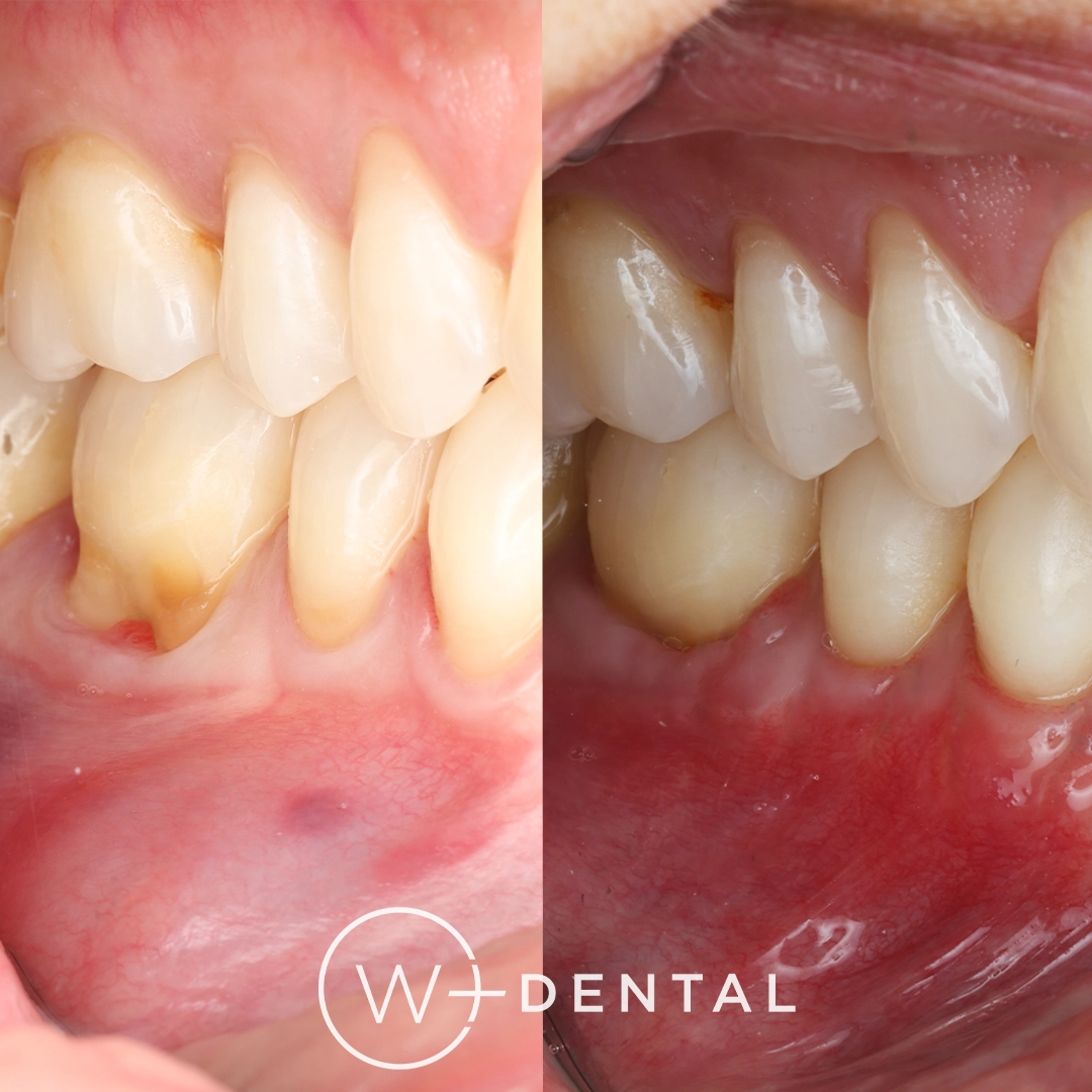 before and after dental bonding for a chipped tooth