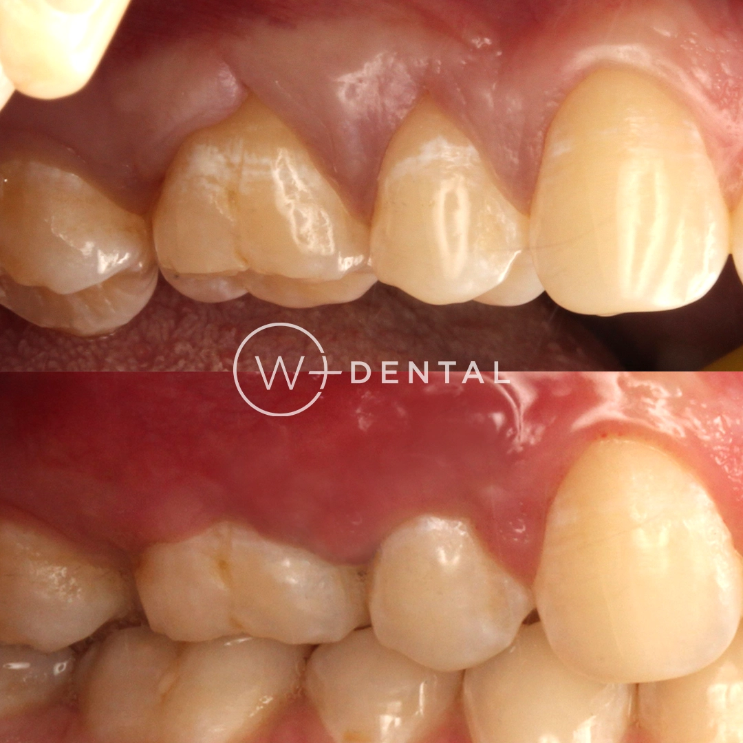 Before and after gum grafting for gum recession using a CTG gum graft
