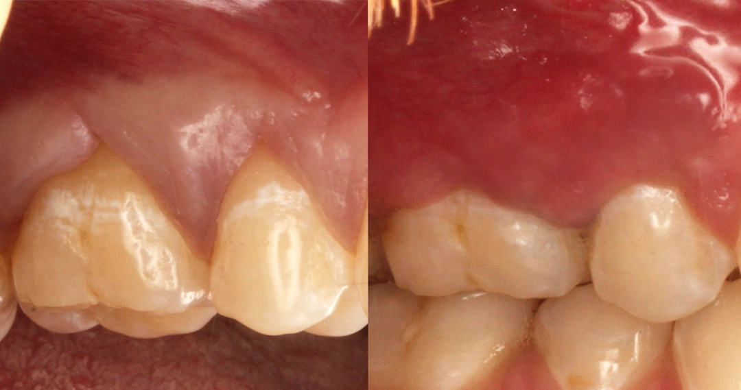 before and after dental bonding for a chipped tooth