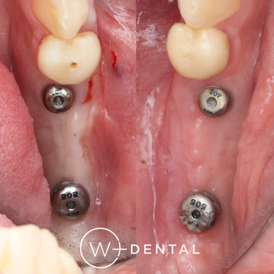 Before and after gum grafting for gum recession around a dental implant