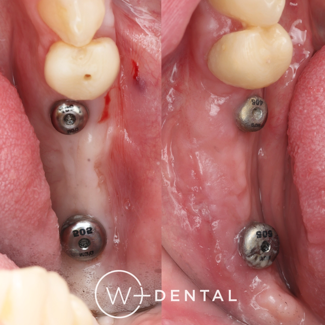 before and after dental bonding for a chipped tooth
