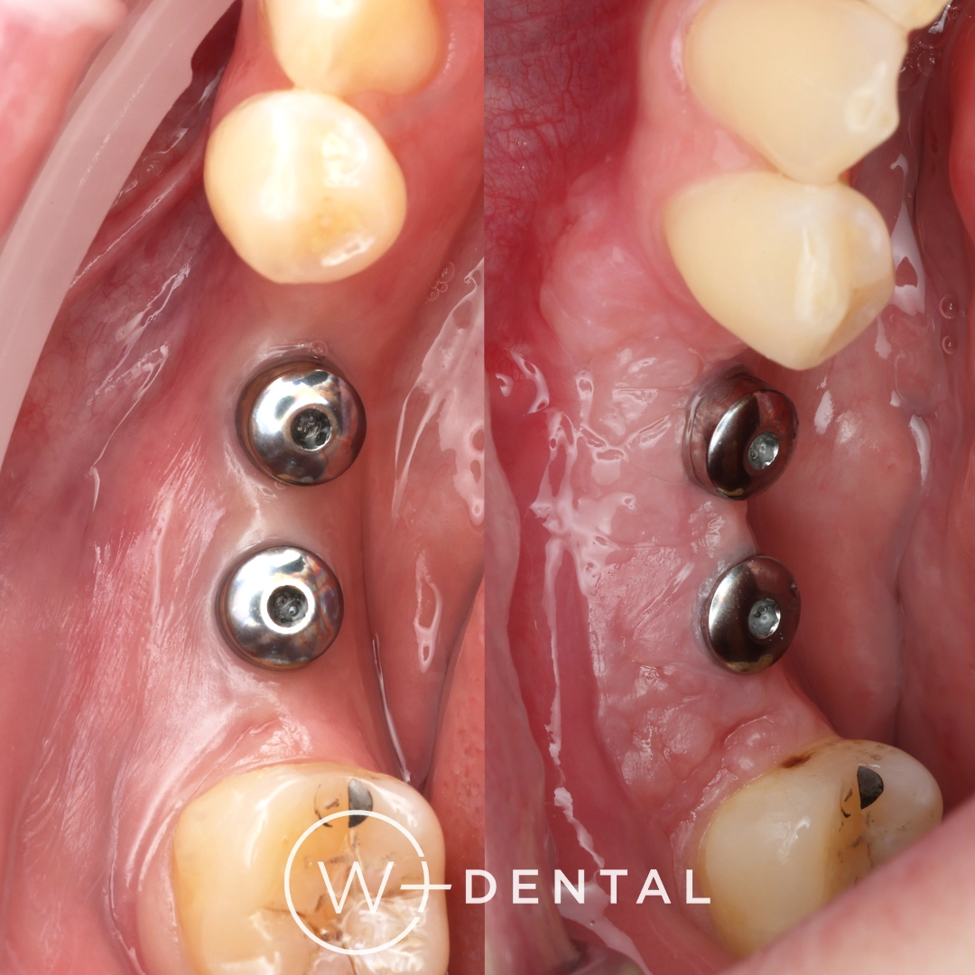 before and after dental bonding for a chipped tooth