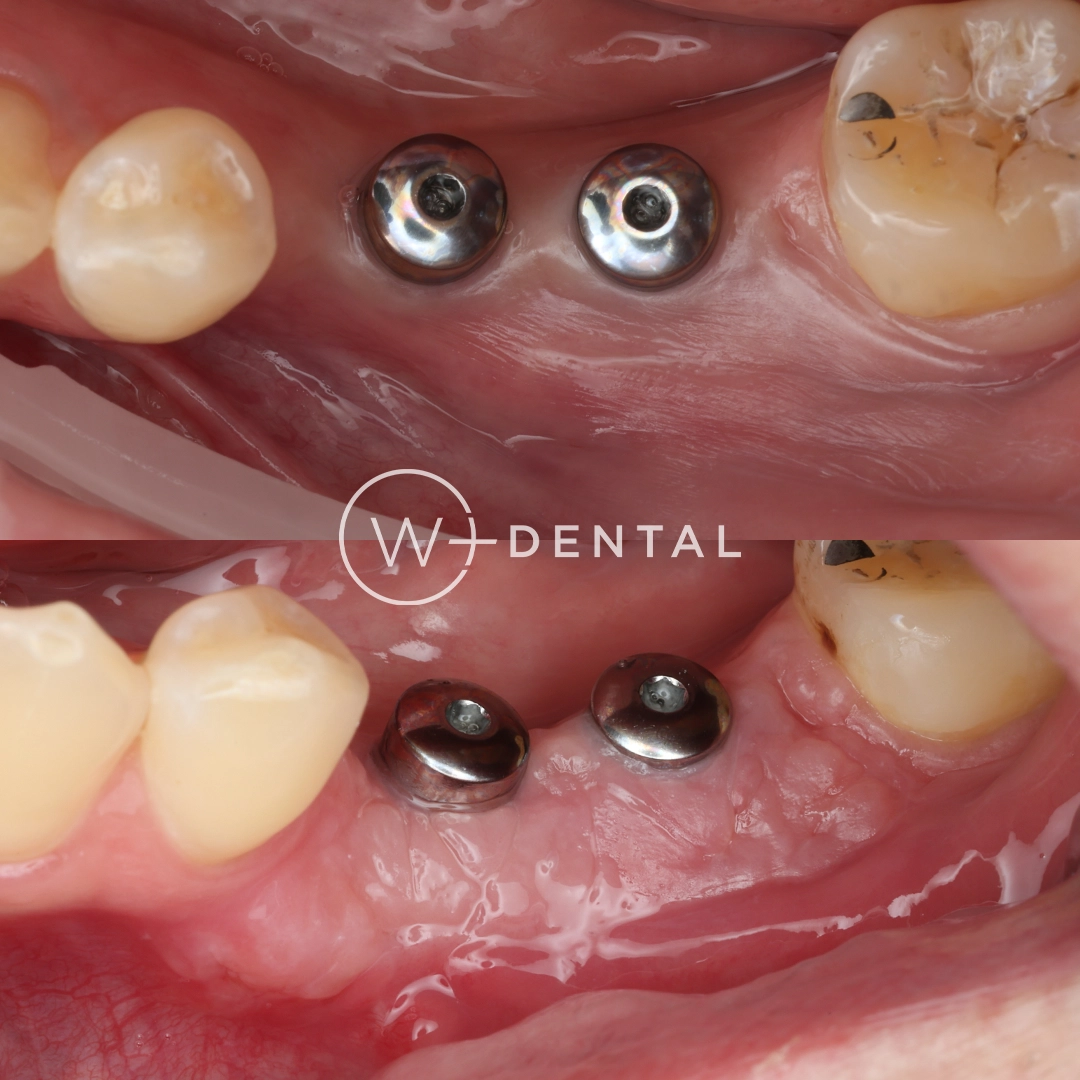 Before and after gum grafting for gum recession around a dental implant