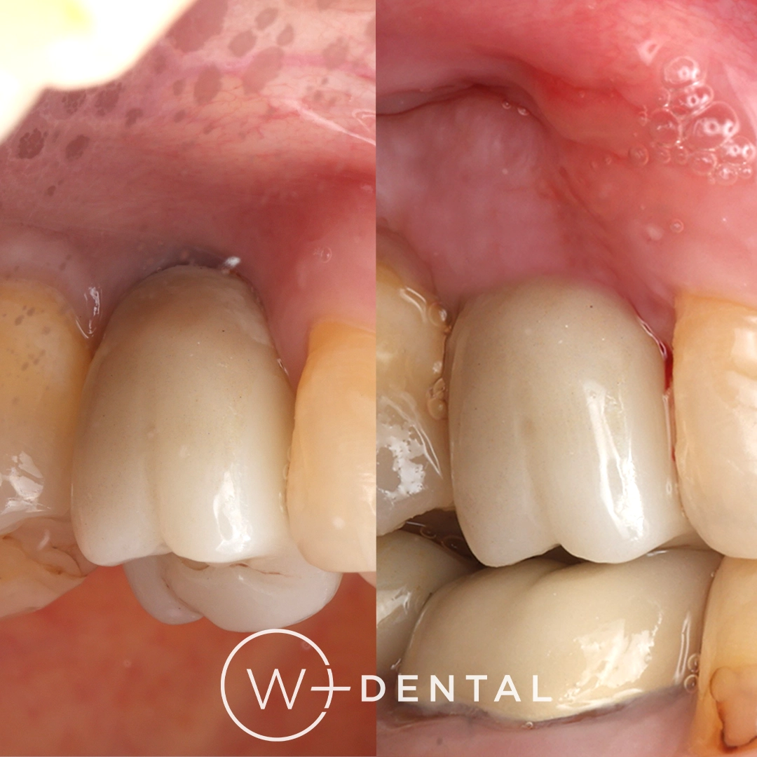 Before and after gum grafting for gum recession around a dental implant