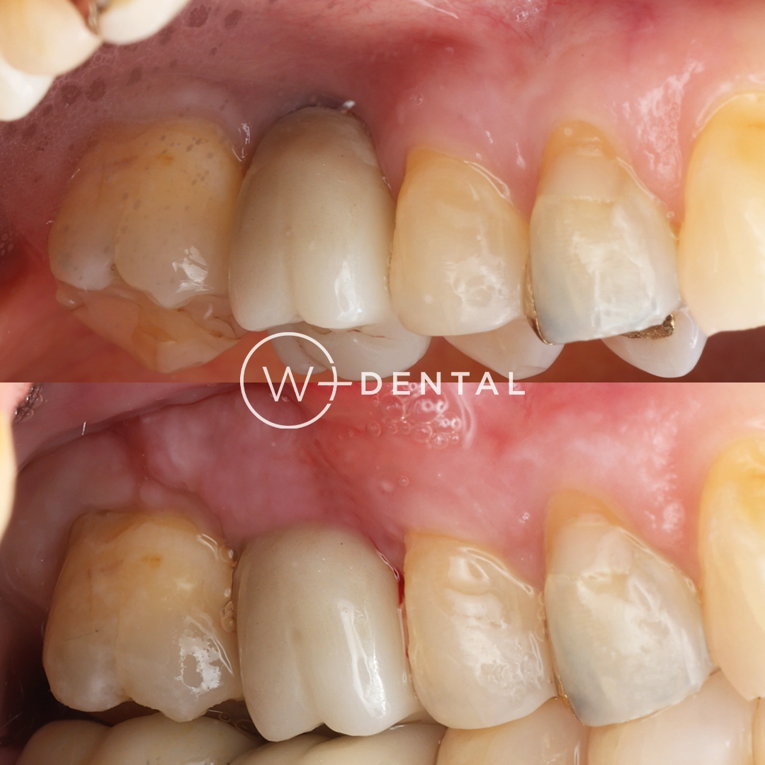 before and after dental bonding for a chipped tooth