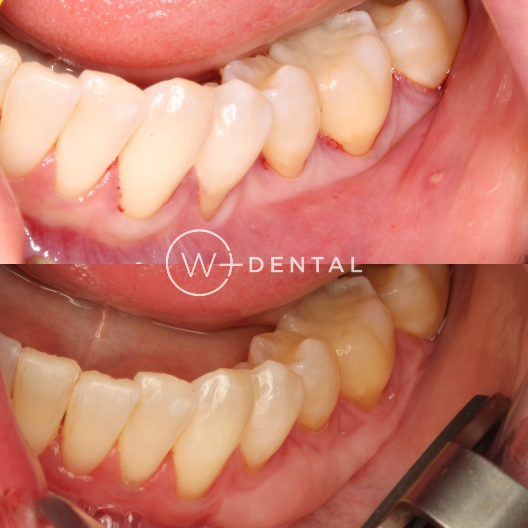 before and after dental bonding for a chipped tooth