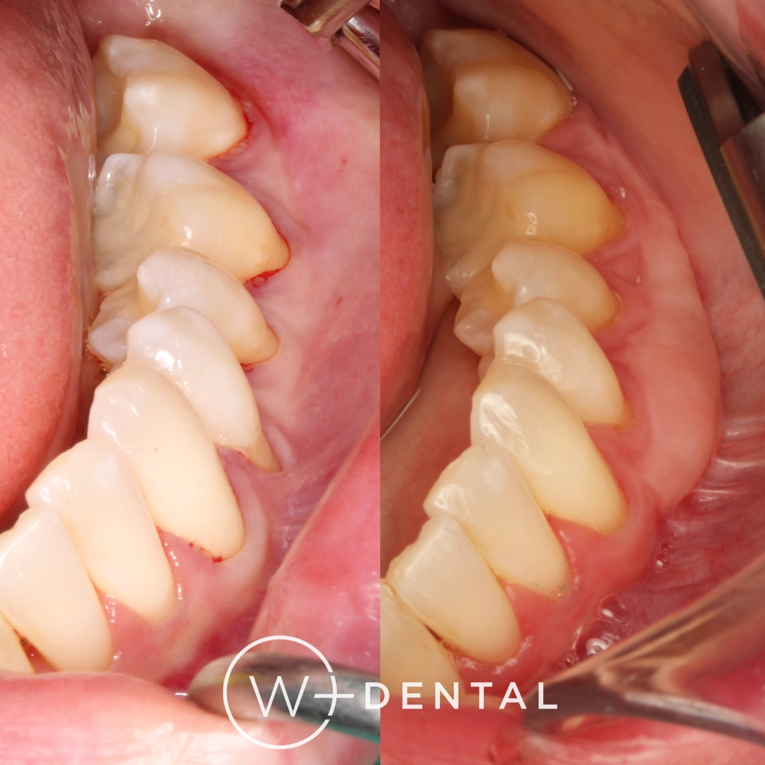 Gum recession before and after root coverage with gum graft