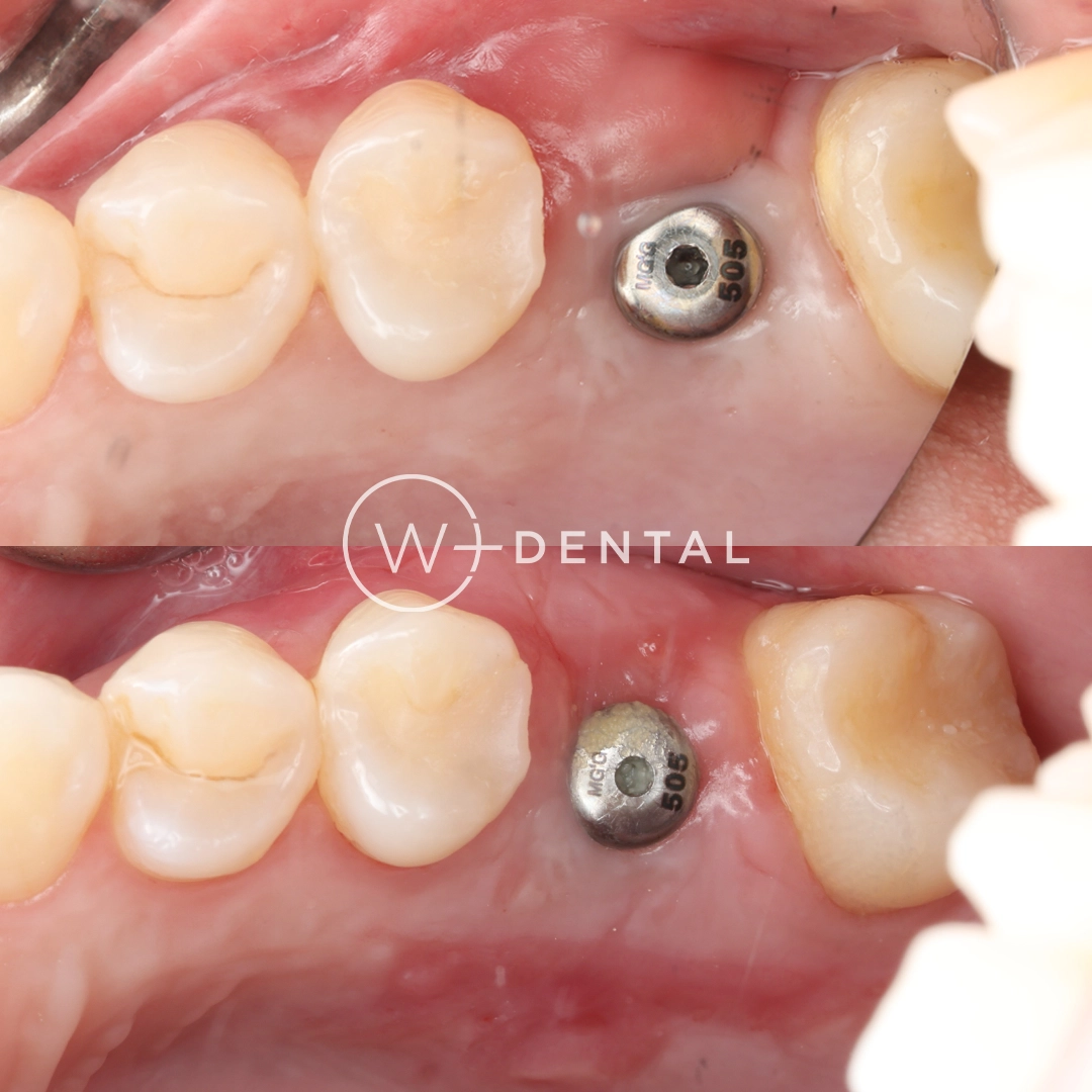 Before and after gum grafting for gum recession around a dental implant
