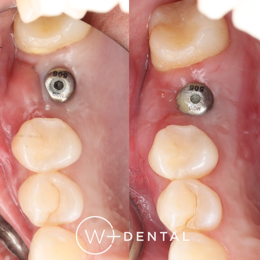 before and after dental bonding for a chipped tooth