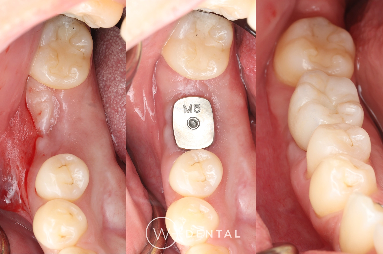 before and after dental bonding for a chipped tooth