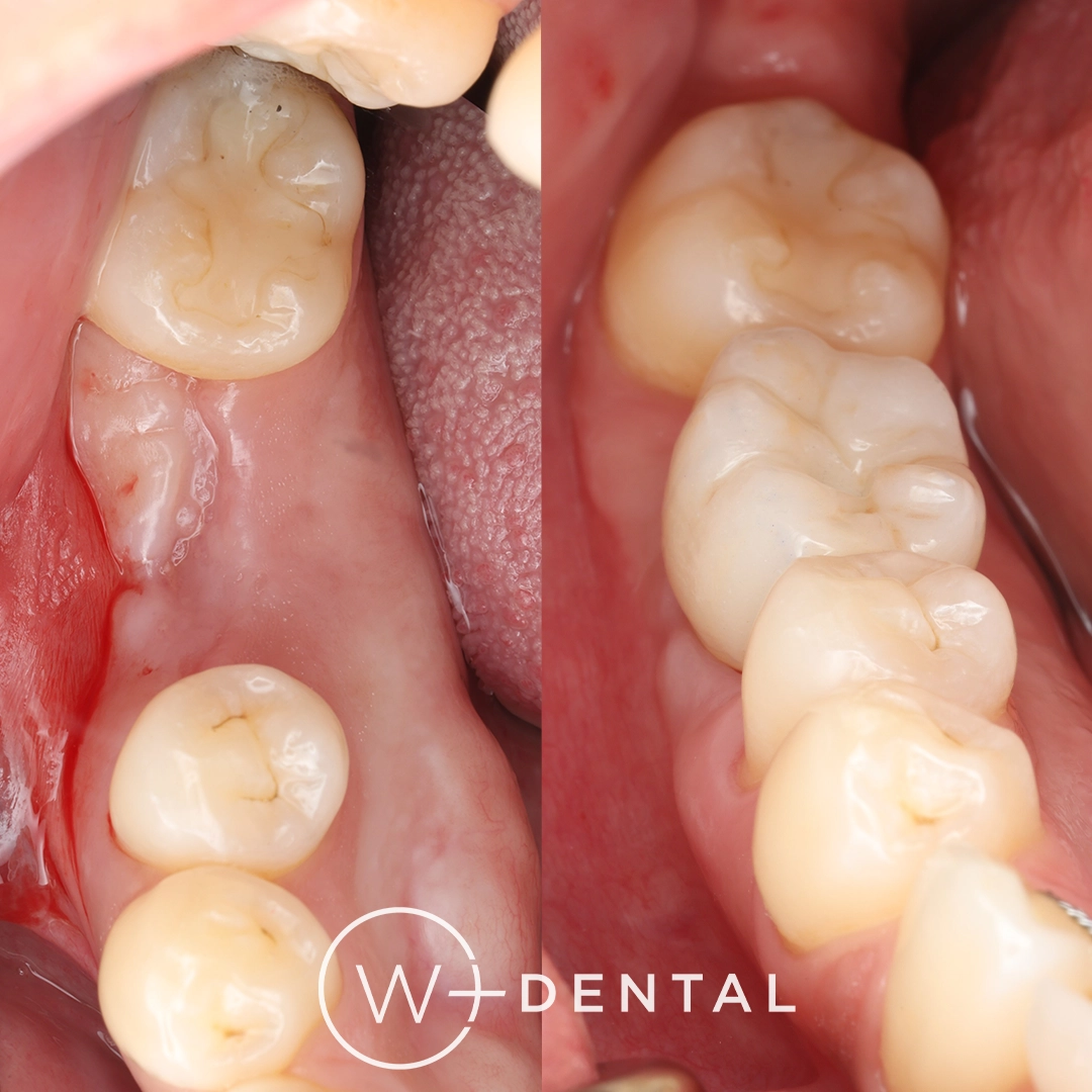 Before and after dental implants at W Plus Dental – patient's smile transformation showing missing tooth replaced with natural-looking implant, Washington DC