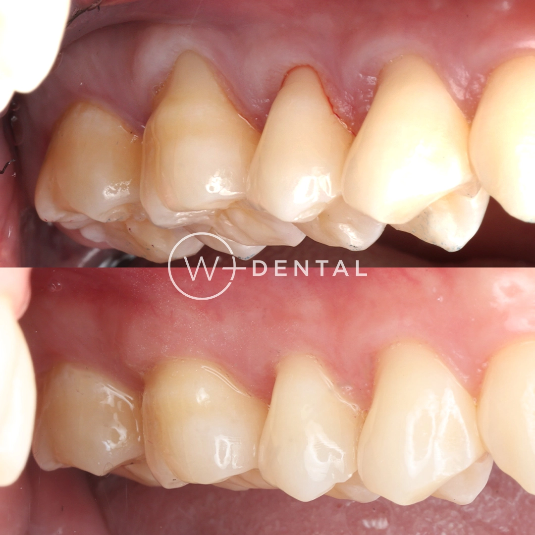 Before and after gum grafting for gum recession using a connective tissue graft