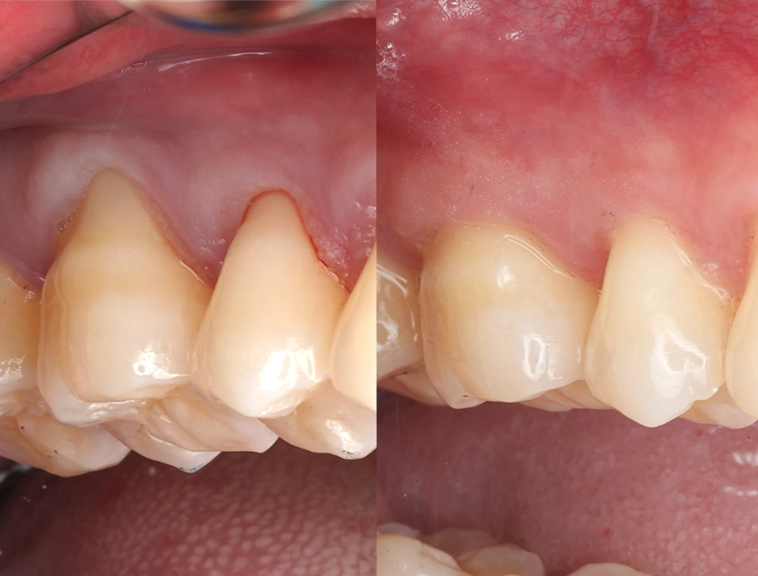 before and after dental bonding for a chipped tooth